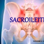 Ejercicios para la sacroileitis o falsa ciática
